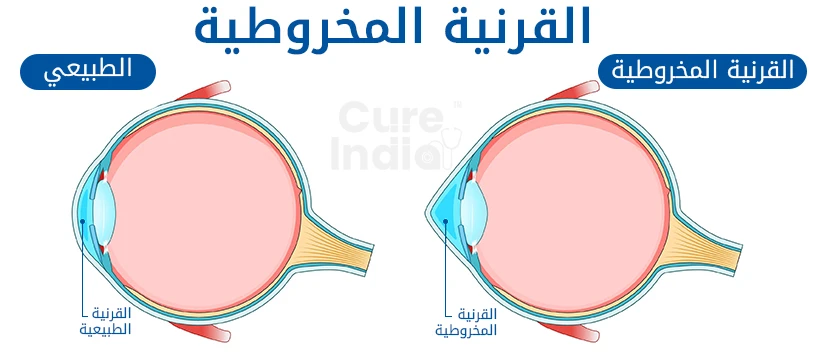 القرنية المخروطية